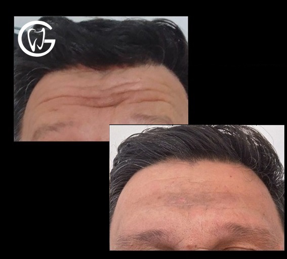 Antes e depois botox masculino em jacareí