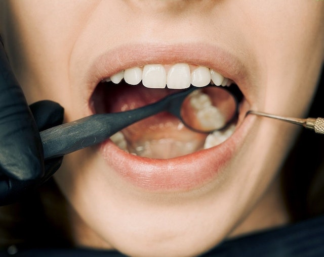 limpeza dental também conhecida como limpeza dentista em jacareí