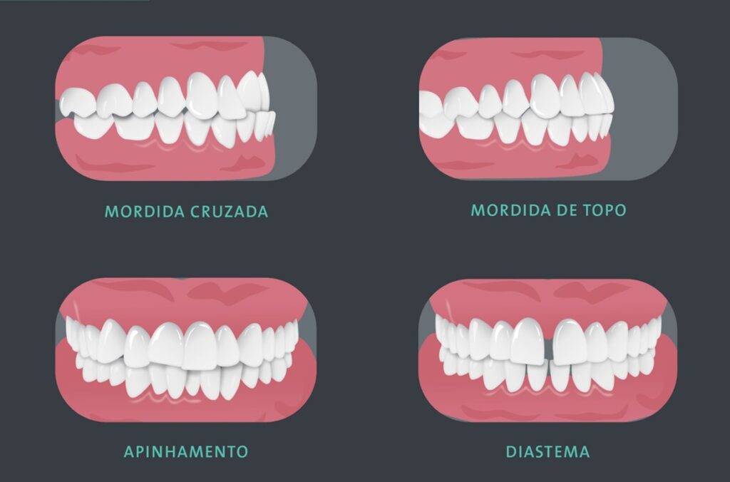 Casos para qual é indicado o aparelho ortodontico